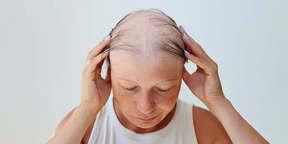 Alopecia - MediPRO