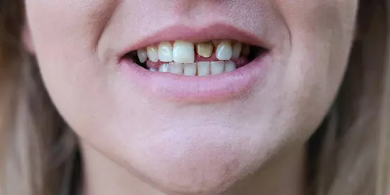 Problemas dientes